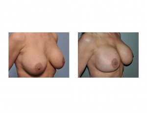 breast-implant-exchange-dr-barry-eppley-indianapolis-oblique-view