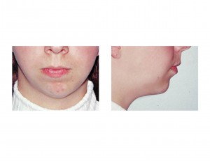 chin-asymmetry-dr-barry-eppley-indianapolis