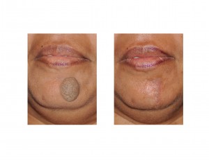 chin-nevi-excision-dr-barry-eppley-indianapolis