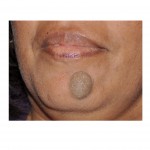 chin-nevi-large-dr-barry-eppley-indianapolis