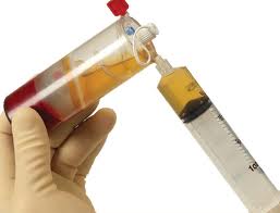platelet-rich-plasma-in-plastic-surgery-dr-barry-eppley-indianapolis