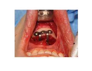 shifting-chin-osteotomy-dr-barry-eppley-indianapolis