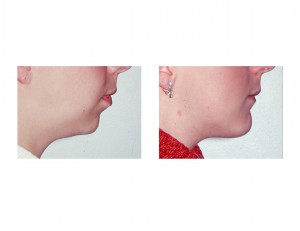 sliding-genioplasty-dr-barry-eppley-indianapolis