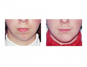 sliding-genioplasty-front-view-dr-barry-eppley-indianapolis