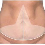 Fleur-de-lis Tummy Tuck design Dr Barry Eppley Indianapolis