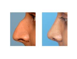 Radix Augmentation in Rhinoplasty Dr Barry Eppley Indianapolis