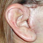 Short Scar Facelift Dr Barry Eppley Indianapolis