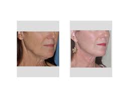 Short Scar Facelift result Indianapolis Dr Barry Eppley
