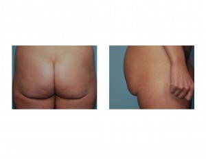 buttock-sagging-ddr-barry-eppley-indianapolis