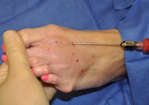 fat-injections-to-the-feet-dr-barry-eppley-indianapolis1