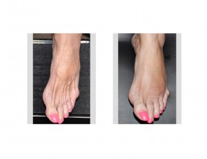 foot-rejuvenation-with-fat-dr-barry-eppley-indianapolis