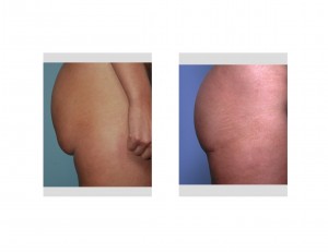 lower-buttock-lift-result-side-view-dr-barry-eppley-indianapolis