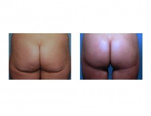 lower-buttock-lift-results-back-view-dr-barry-eppley-indianapolis