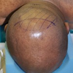 occipital-cranioplasty-design-dr-barry-eppley-indianapolis1