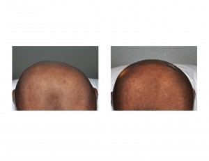 occipital-cranioplasty-result-back-view-dr-barry-eppley-indianapolis