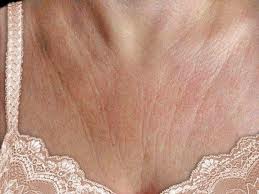 wrinkled-cleavage-dr-barry-eppley-indianapolis