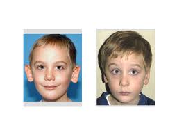 Eppley Otoplasty Surgery Indianapolis