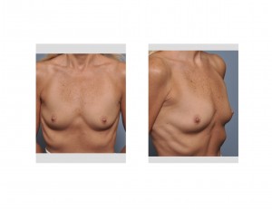 Aging Breasts Dr Barry Eppley Indianapolis