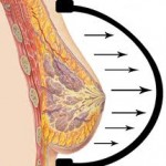 Brava Breast Device Expansion Dr Barry Eppley Indianapolis