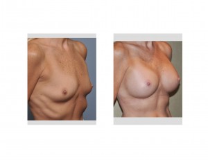 Breast Rejuvenationk with Implants oblique view Dr Barry Eppley Indianapolis