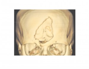 Forehead Bone Defect 3-D CT Scan Dr Barry Eppley Indianapolis
