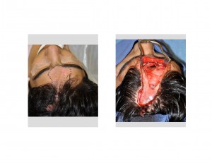 Forehead Bone Defect Dr Barry Eppley Indianapolis