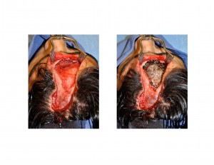 Forehead Mesh Floor Dr Barry Eppley Indianapolis