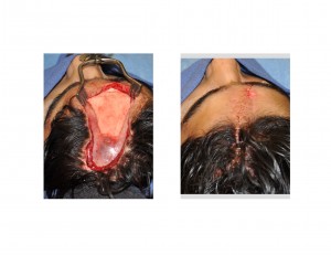 Forehead Reconstructionk Skin Closure Dr Barry Eppley Indianapolis