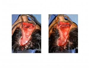 Frontal Sinus Defect Patch Dr Barry Eppley Indianapolis
