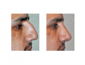 High Radix Rhinoplasty result side view Dr Barry Eppley Indianapolis