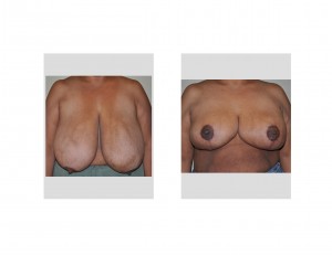 Large Breast Reduction front view Dr Barry Eppley Indianapolis