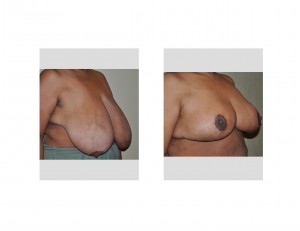 Large Breast Reduction oblique view Dr Barry Eppley Indianapolis