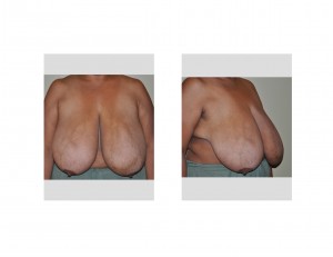 Large Breasts Dr Barry Eppley Indianapolis