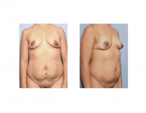 Mommy Makeover before surgery Dr Barry Eppley Indianapolis