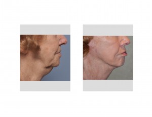 Octogenarianj Facelift result side view Dr Barry Eppley Indianapolis