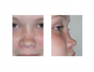Saddle Nose Deformity before surgery Dr Barry Eppley