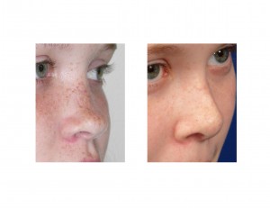 Saddle Nose Rib Graft Rhinoplasty Dr Barry Eppley Indianapolis