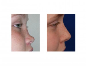 Saddle Nose Rib Graft Rhinoplasty result side view Dr Barry Eppley Indianapolis