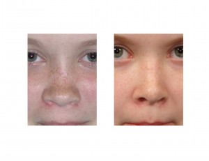 Saddle Nose Rib Graft Rhinoplasty results front viewDr Barry Eppley Indianapolis