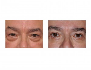 Male Blepharoplasty Dr Barry Eppley Indianapolis