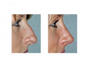 Witch's Nose Rhinoplasty result side view