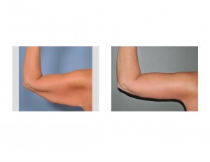 Brachioplasty left Arm result back view