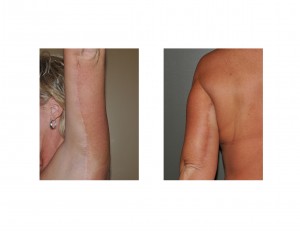 Brachioplasty scars left arm