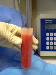 Injectable Fat Grafting Dr Eppley Indianapolis