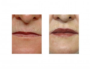Lip Advancements Indianapolis Dr Barry Eppley