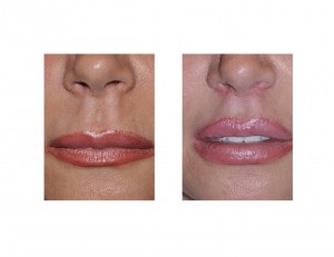 Lip Lifts Indianapolis Dr Barry Eppley