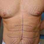 Abdominal Etching surgica plan Dr Barry Eppley Indianapolis
