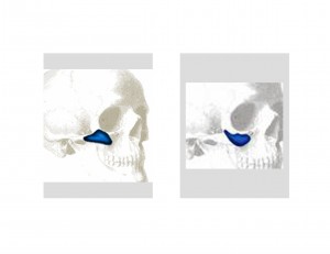 Cheek Implant Styles Dr Barry Eppley Indianapolis