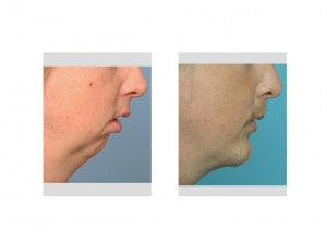 Chin Osteotomy and Implant Augmentation result side view Dr Barry Eppley Indianapolis