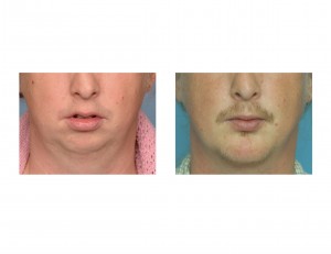 Chin Osteotomy and Implant Combo results front view